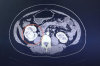右肾被肿瘤“侵占”，腹腔镜下完美“切癌保肾”